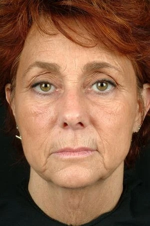 Facelift Before and After Photo by Dr. Hugo in Virginia Beach