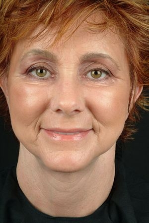 Facelift Before and After Photo by Dr. Hugo in Virginia Beach