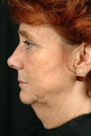 Facelift
