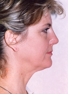 Facelift
