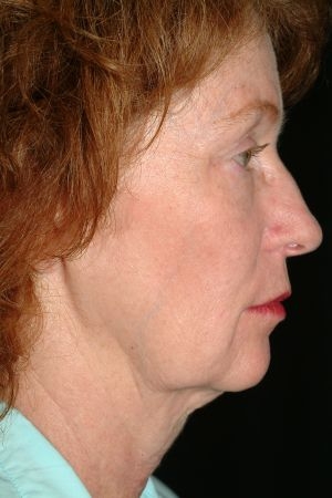 Facelift