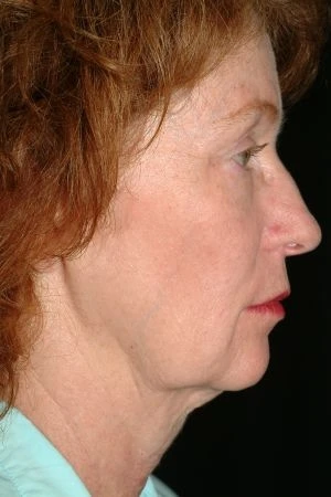 Facelift