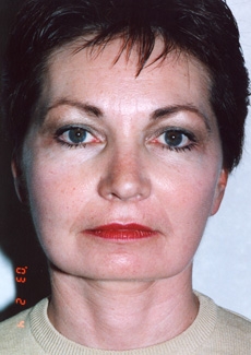 Facelift