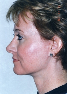 Facelift