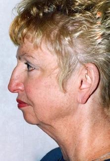 Facelift