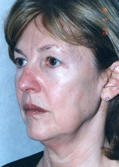 Facelift