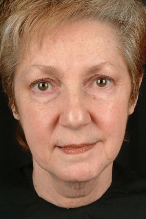 Mini Facelift Virginia Beach