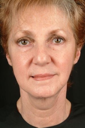 Mini Facelift Results Virginia Beach