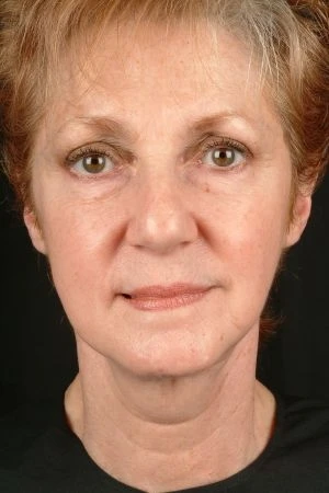 Mini Facelift Results Virginia Beach