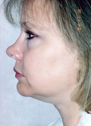 Facial Liposuction