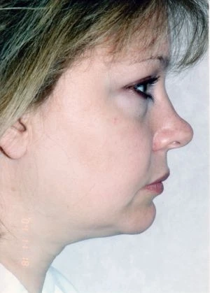 Facial Liposuction
