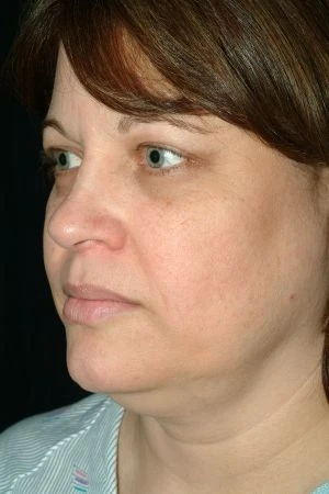 Facial Liposuction