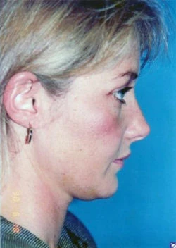 Facial Liposuction