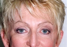 Brow Lift