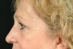 Brow Lift