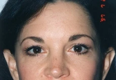Brow Lift