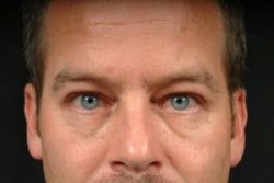 Blepharoplasty (Eyelid Surgery)