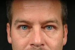 Blepharoplasty (Eyelid Surgery)