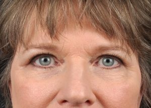 Blepharoplasty (Eyelid Surgery)