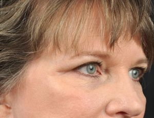 Blepharoplasty (Eyelid Surgery)