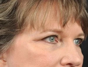Blepharoplasty (Eyelid Surgery)