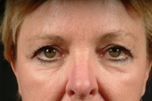 Blepharoplasty Eyelid Surgery Results Virginia Beach