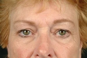 Blepharoplasty (Eyelid Surgery)