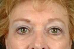 Blepharoplasty (Eyelid Surgery)