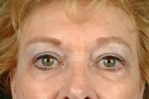 Blepharoplasty (Eyelid Surgery)
