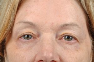 Blepharoplasty (Eyelid Surgery)