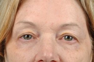 Blepharoplasty (Eyelid Surgery)