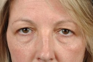 Blepharoplasty (Eyelid Surgery)