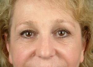 Blepharoplasty (Eyelid Surgery)
