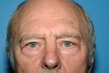 Blepharoplasty (Eyelid Surgery)