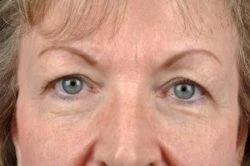 Blepharoplasty (Eyelid Surgery)