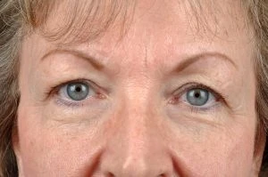 Blepharoplasty (Eyelid Surgery)