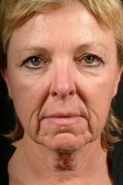 Blepharoplasty (Eyelid Surgery)