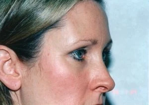 Blepharoplasty (Eyelid Surgery)