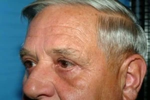 Blepharoplasty (Eyelid Surgery)