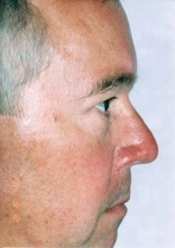 Blepharoplasty (Eyelid Surgery)