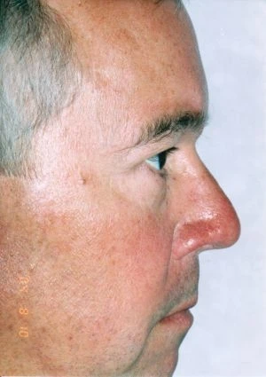 Blepharoplasty (Eyelid Surgery)