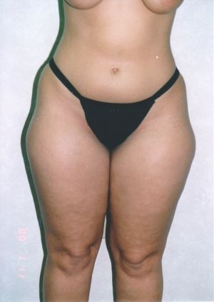 Liposuction