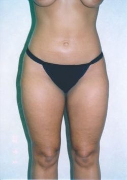 Liposuction