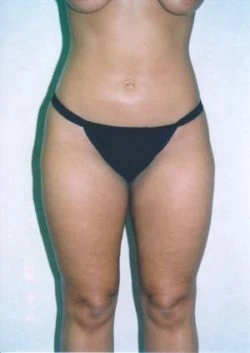 Liposuction