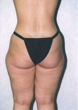 Liposuction