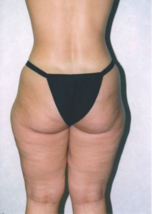 Liposuction