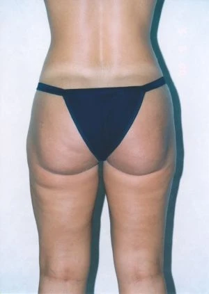 Liposuction