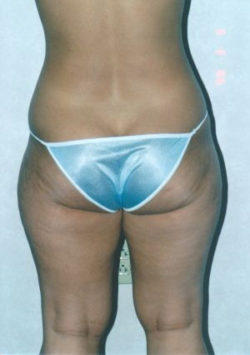 Liposuction