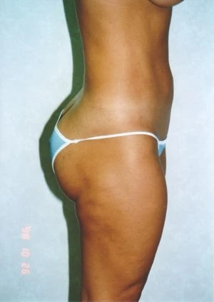 Liposuction