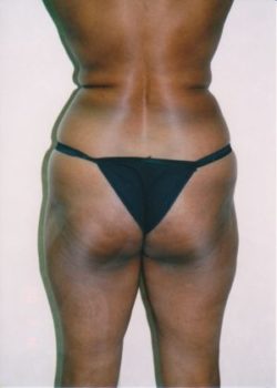 Liposuction